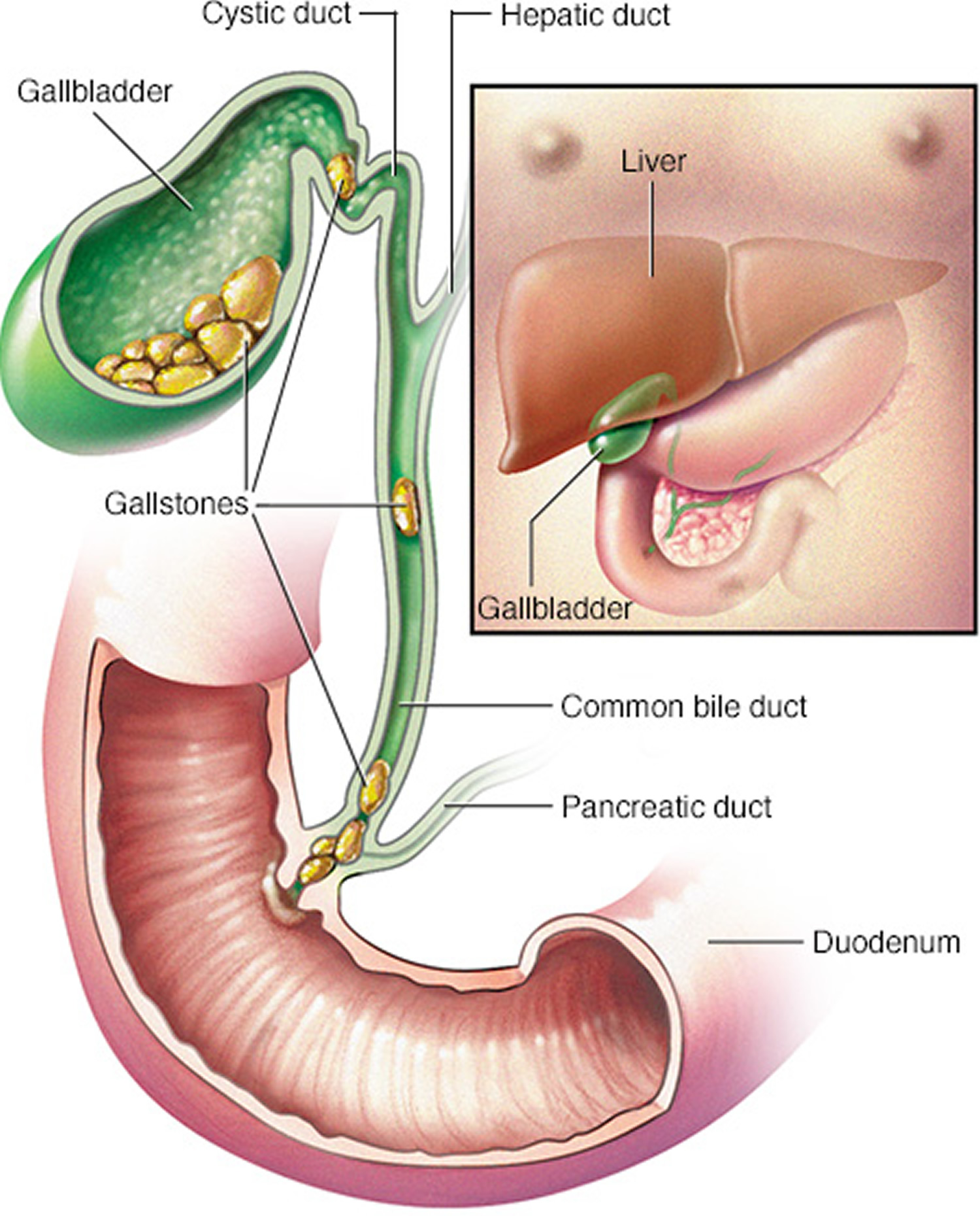 cholecystitis-acute-chronic-causes-symptoms-treatment