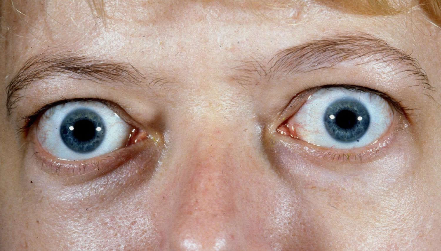 bulging eyeballs disease