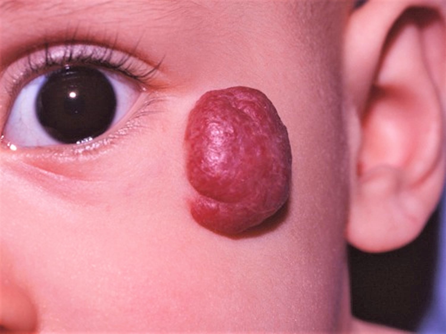 Image result for hemangioma