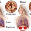 Hiccups