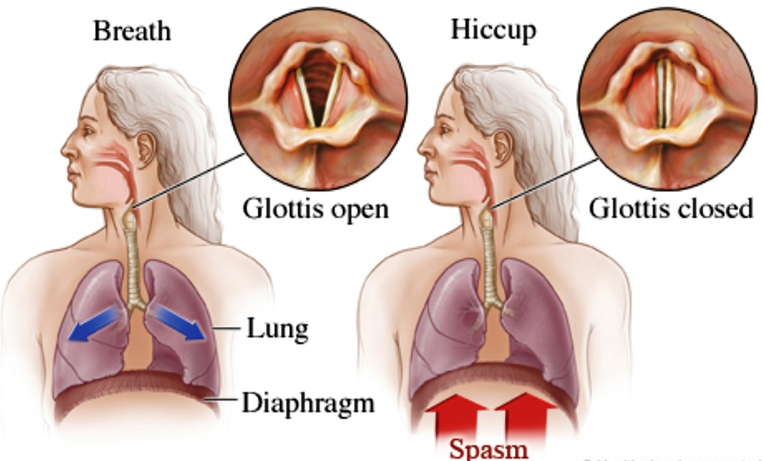 Hiccups Causes Learn How To Stop Get Rid and Prevent Hiccups