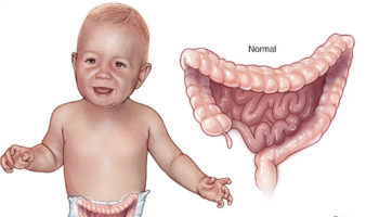 Hirschsprung disease