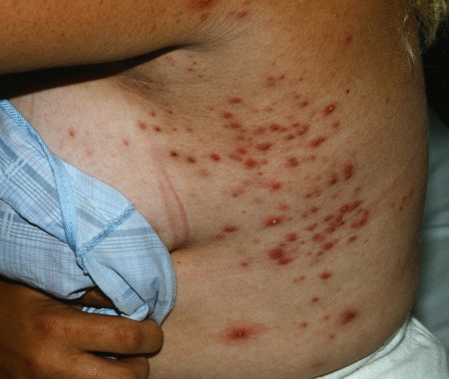 Folliculitis  Causes, Signs, Symptoms, How to Get Rid of Folliculitis