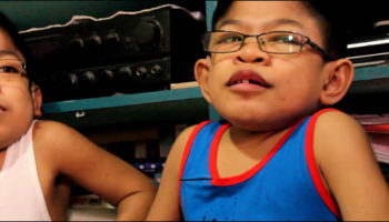 Hunter syndrome