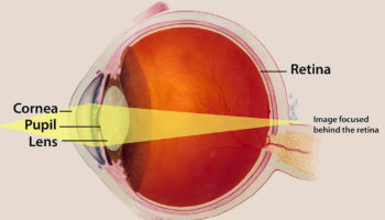 Hyperopia