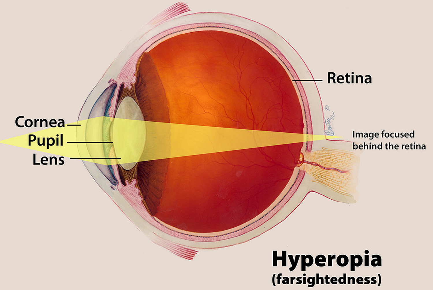 Hyperopia Vision