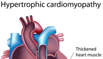 Hypertrophic cardiomyopathy