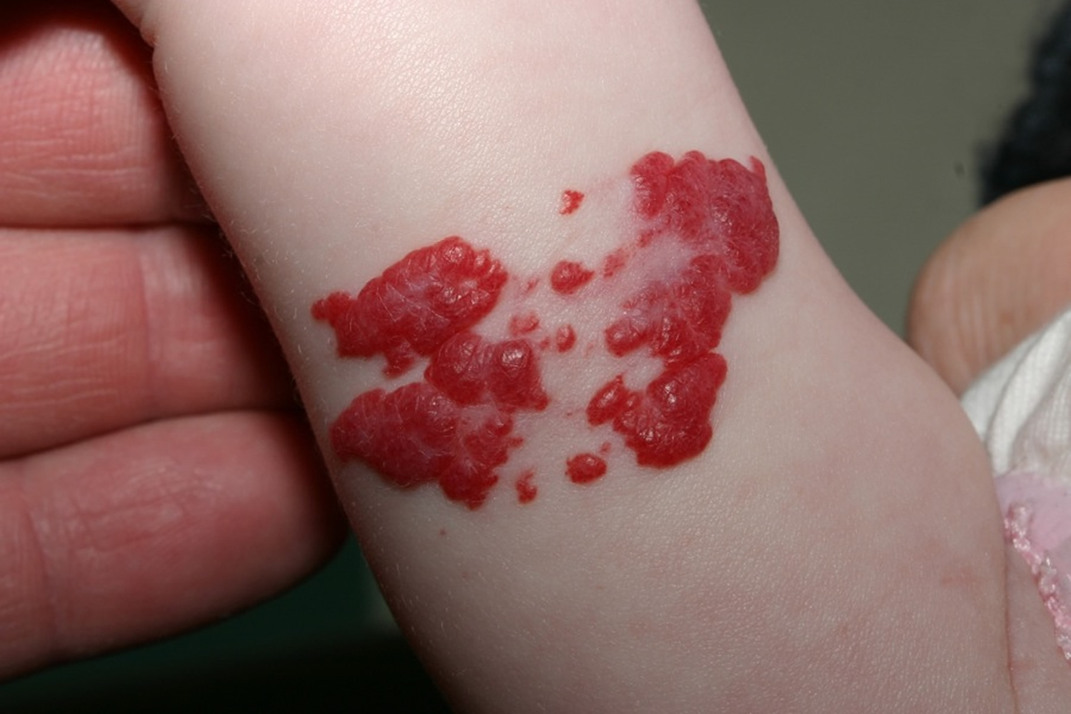 Hemangioma Hemangioma Of Skin Spine Liver Causes And Treatment 