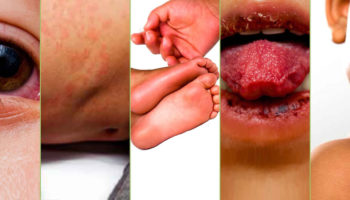 Kawasaki disease