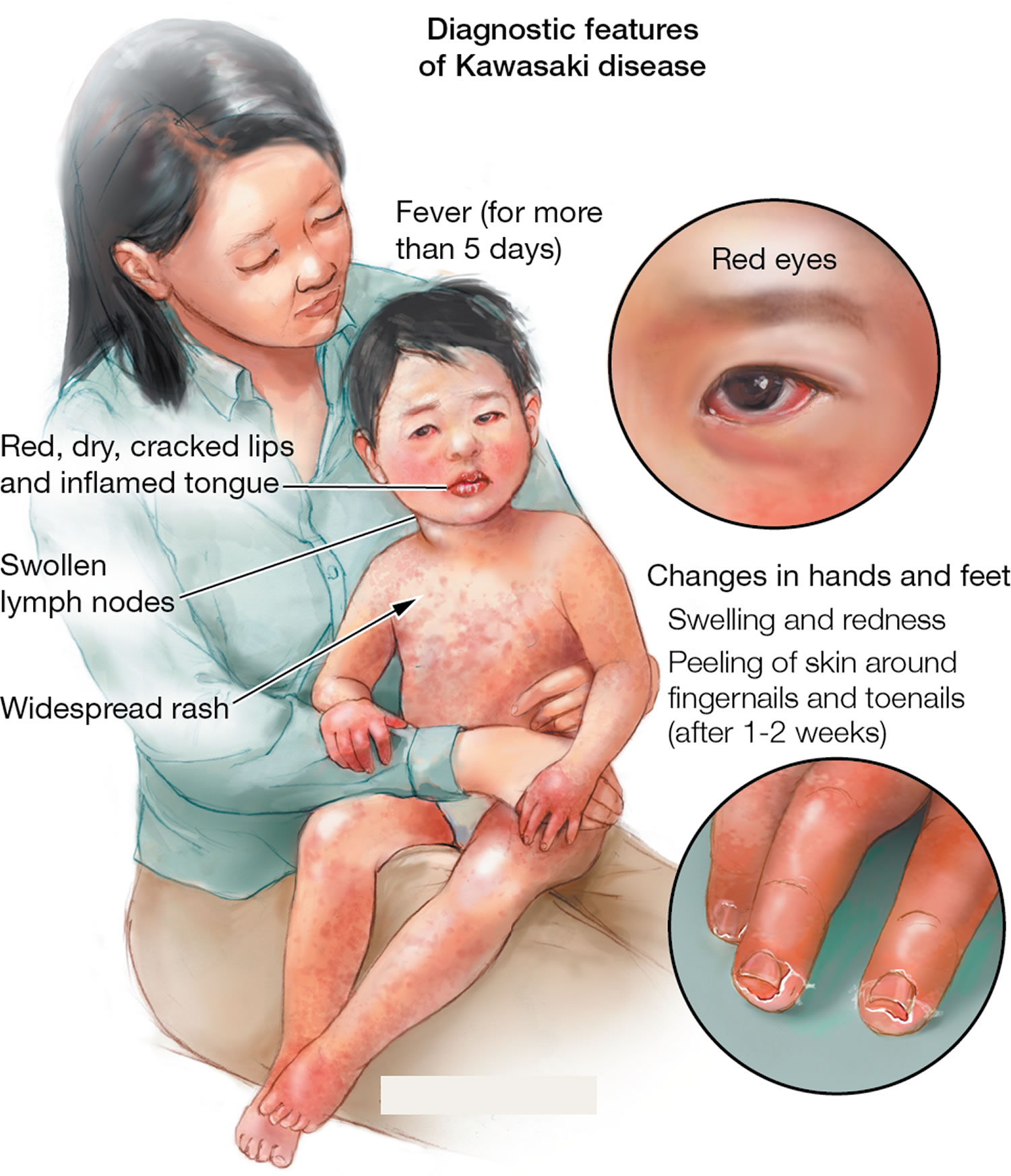 Kawasaki Disease - Causes, Signs, Symptoms,Treatment