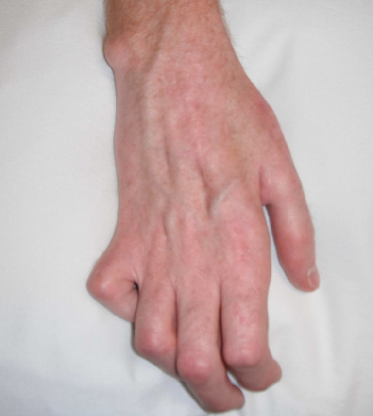 Claw hand causes, signs, symptoms, diagnosis and claw hand treatment