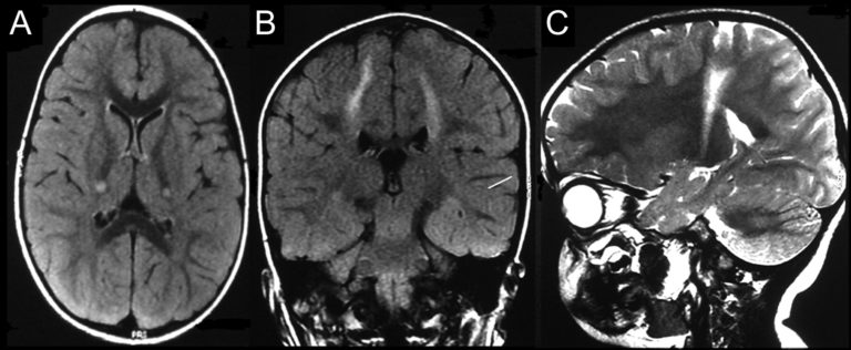 Krabbe Disease - Causes, Symptoms, Life Expectancy, MRI, Treatment