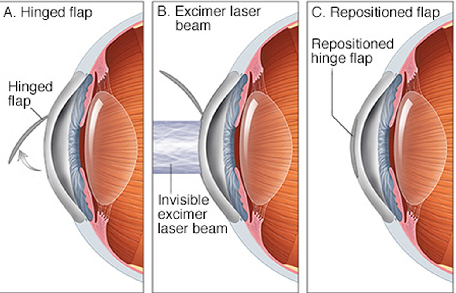 How Does Hyperopic Lasik Work