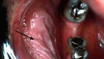 Leukoplakia gum