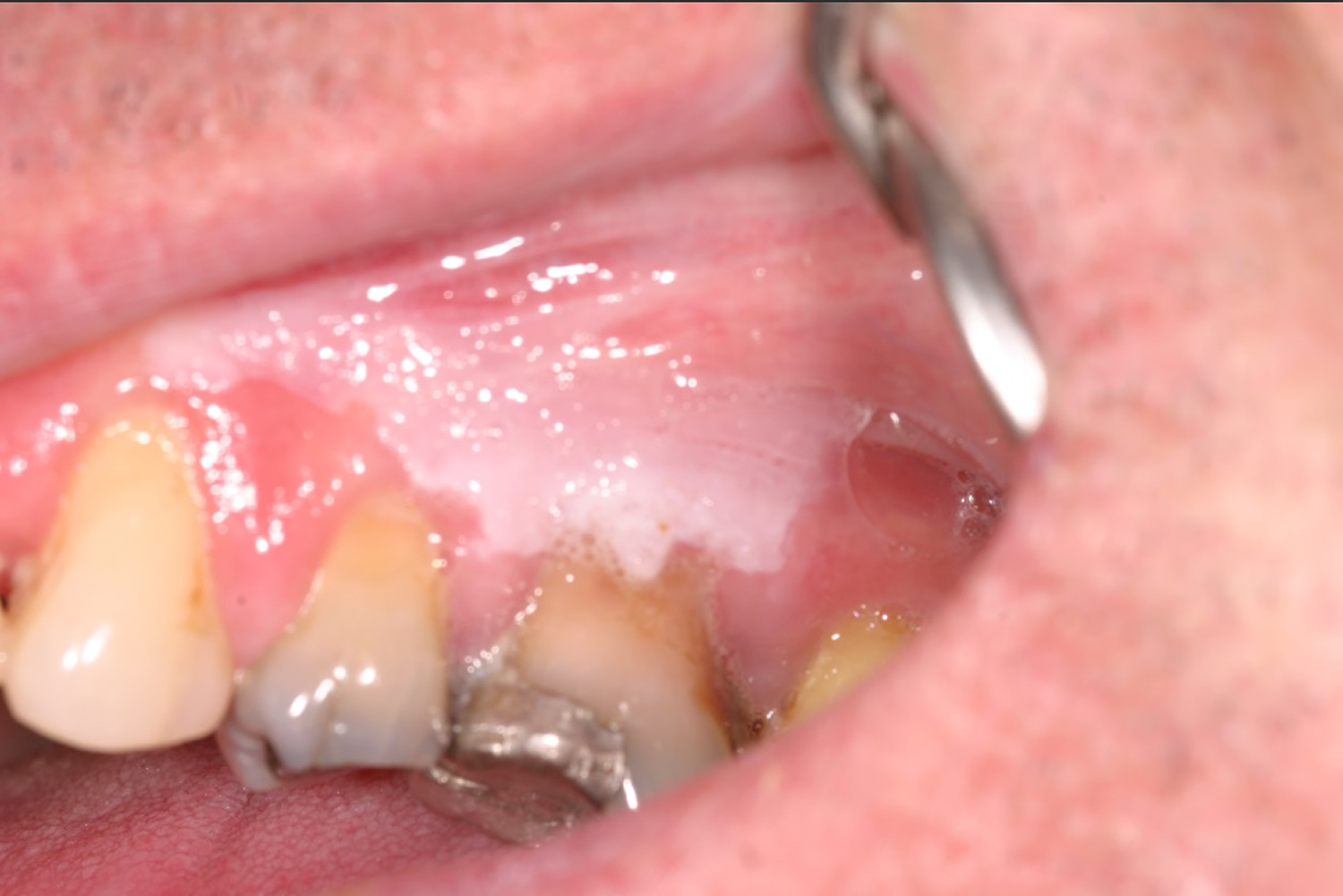 Can Hairy Leukoplakia Be Treated