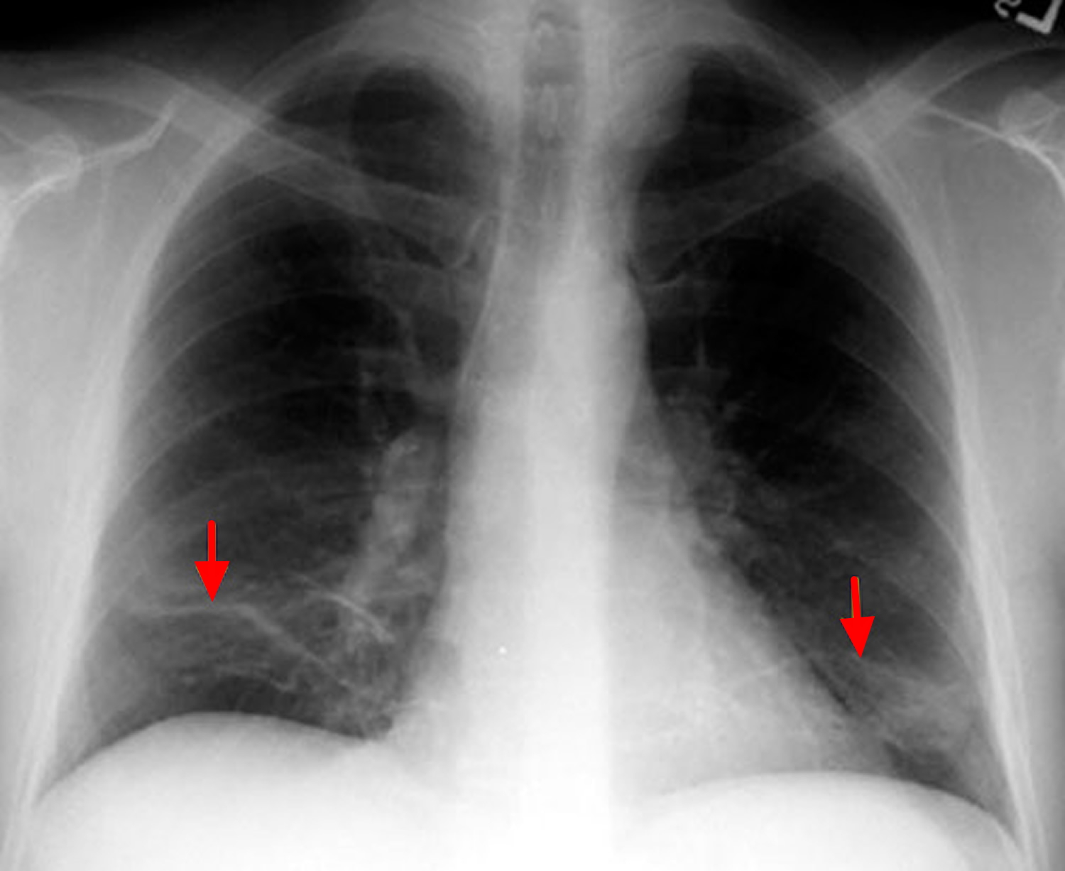 atelectasis-causes-symptoms-atelectasis-treatment