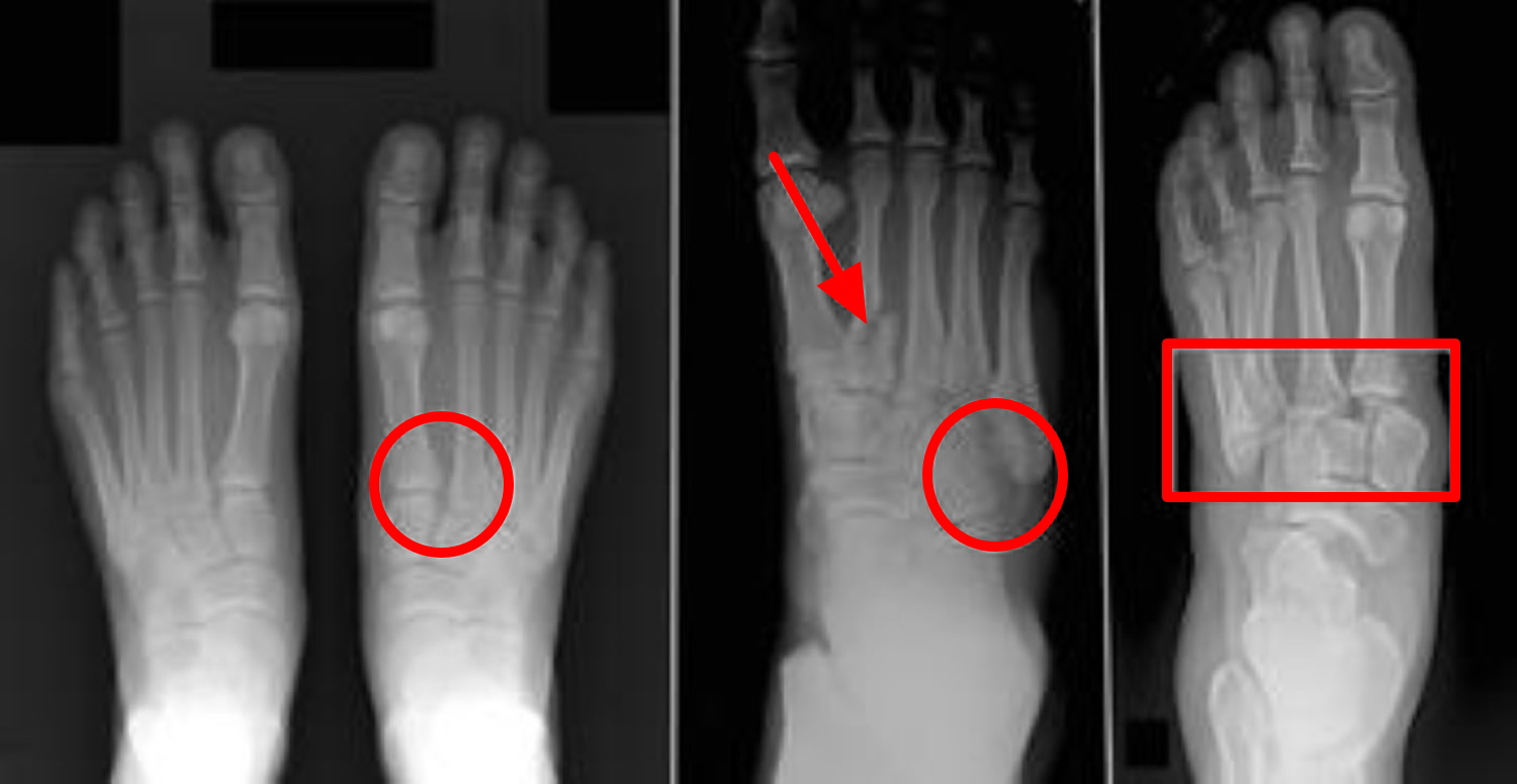Lisfranc midfoot injuries x-ray