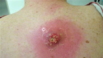 MRSA skin infection 2