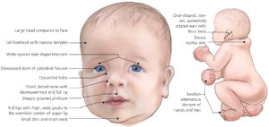 Noonan Syndrome - Causes, Symptoms, Prognosis, Treatment