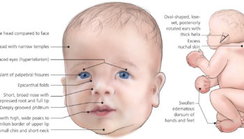 Noonan syndrome baby