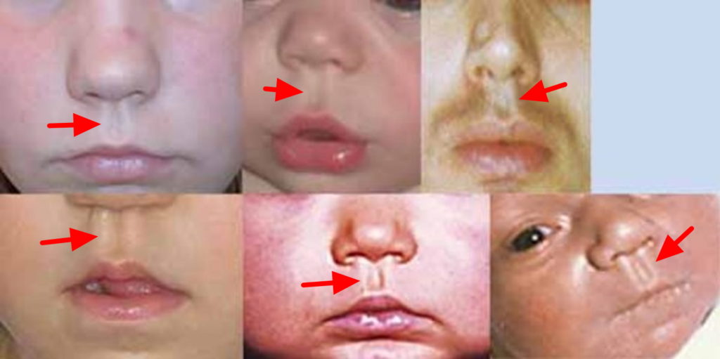 Noonan Syndrome Causes, Symptoms, Prognosis, Treatment