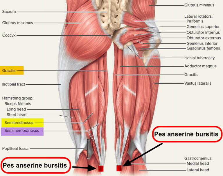 Bursitis - Hip, Trochanteric, Knee, Shoulder, Elbow - Causes & Treatment