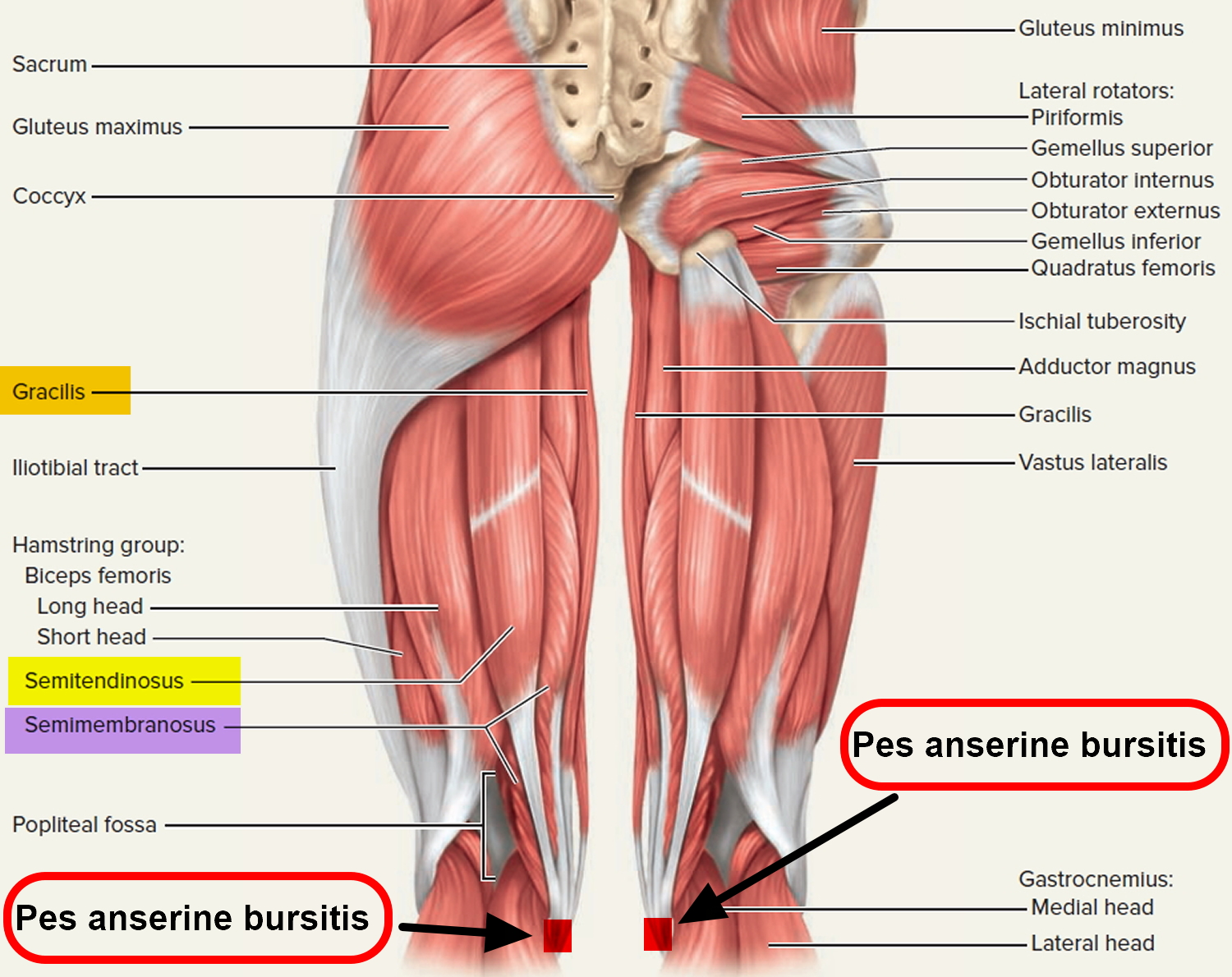 Pes Anserine Bursitis Symptoms Hiveloxa