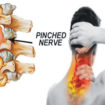 Pinched nerve