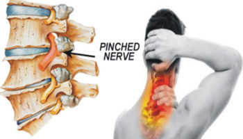 Pinched nerve