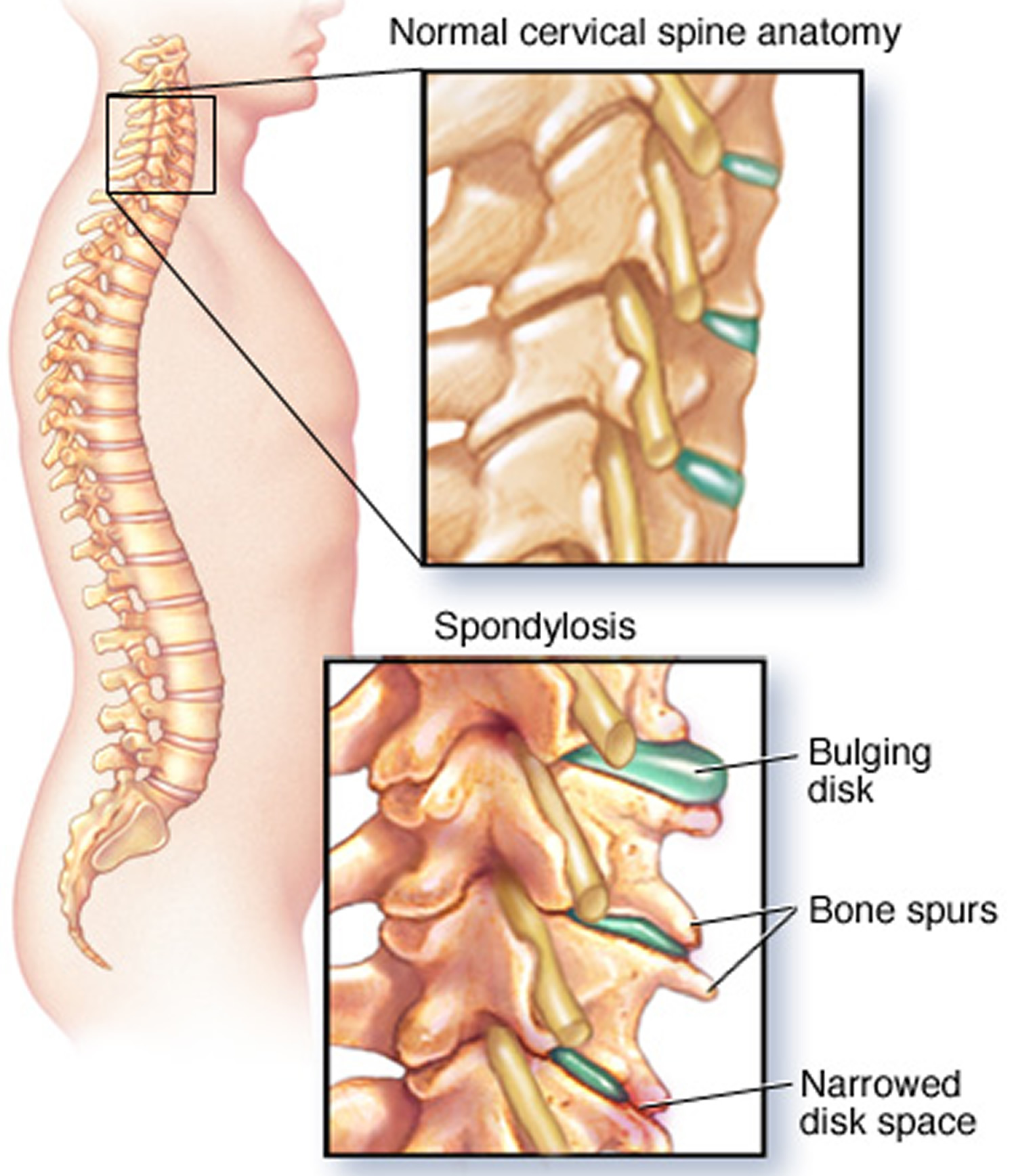 pinched nerve - in neck, arm, shoulder - causes, symptoms & treatment