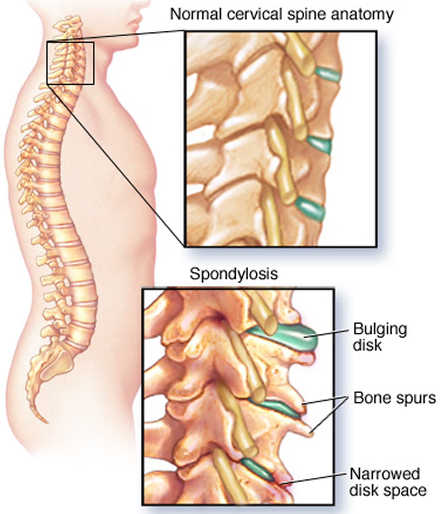 Pinched Nerve In Shoulder Definition