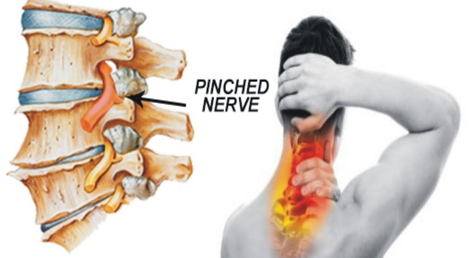 cervical spine nerves impingement x ray