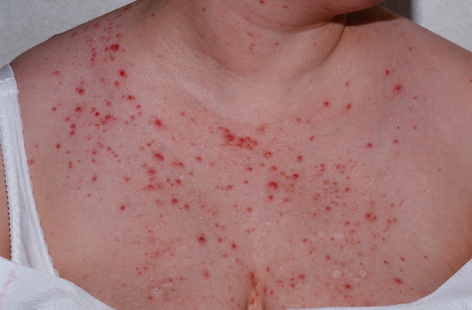 Folliculitis Causes Signs Symptoms How To Get Rid Of Folliculitis