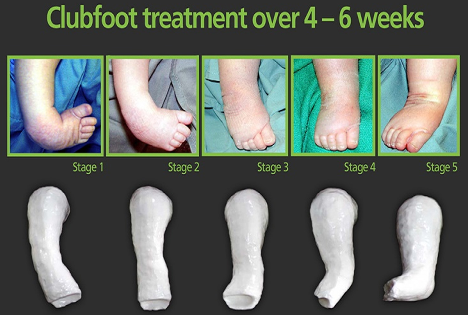 Ponseti method for clubfoot treatment