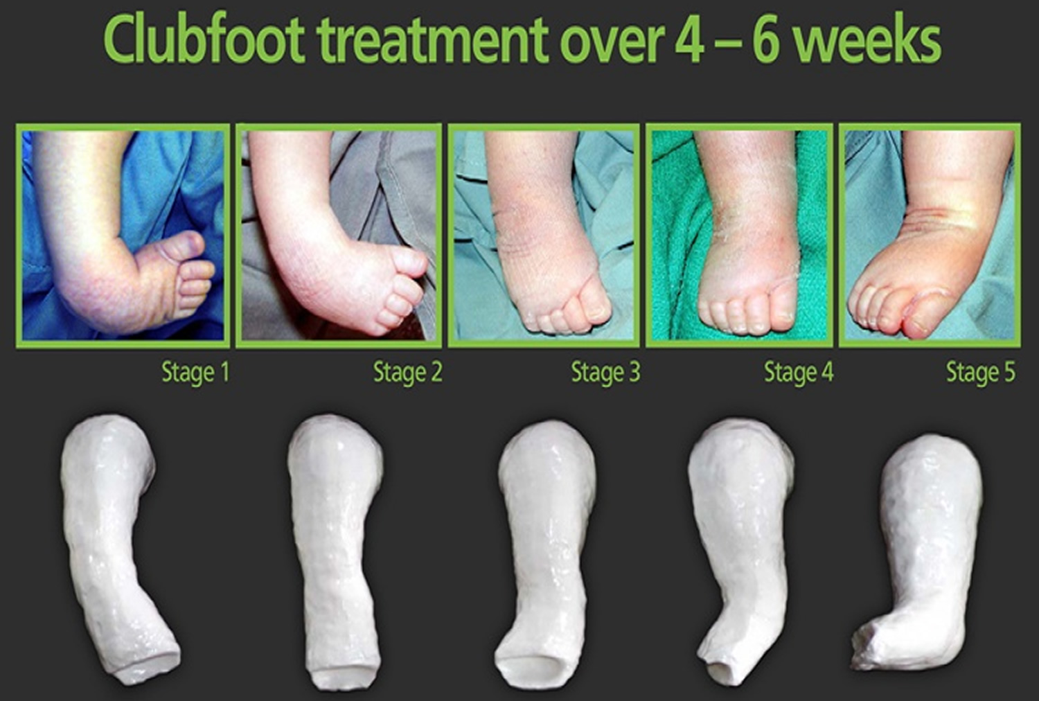 Club Foot - Congenital Clubfoot Causes, Types, Symptoms ...