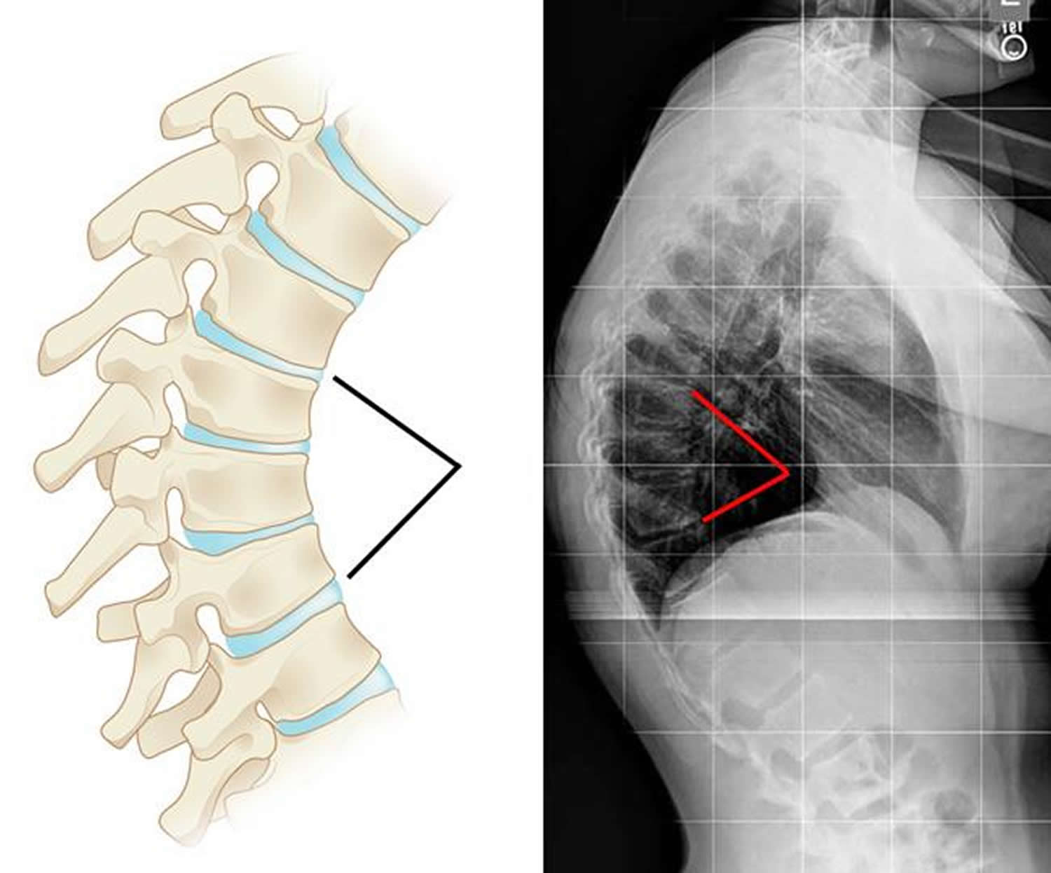 Kyphosis - Causes, Symptoms, Exercises, Surgery, Treatment