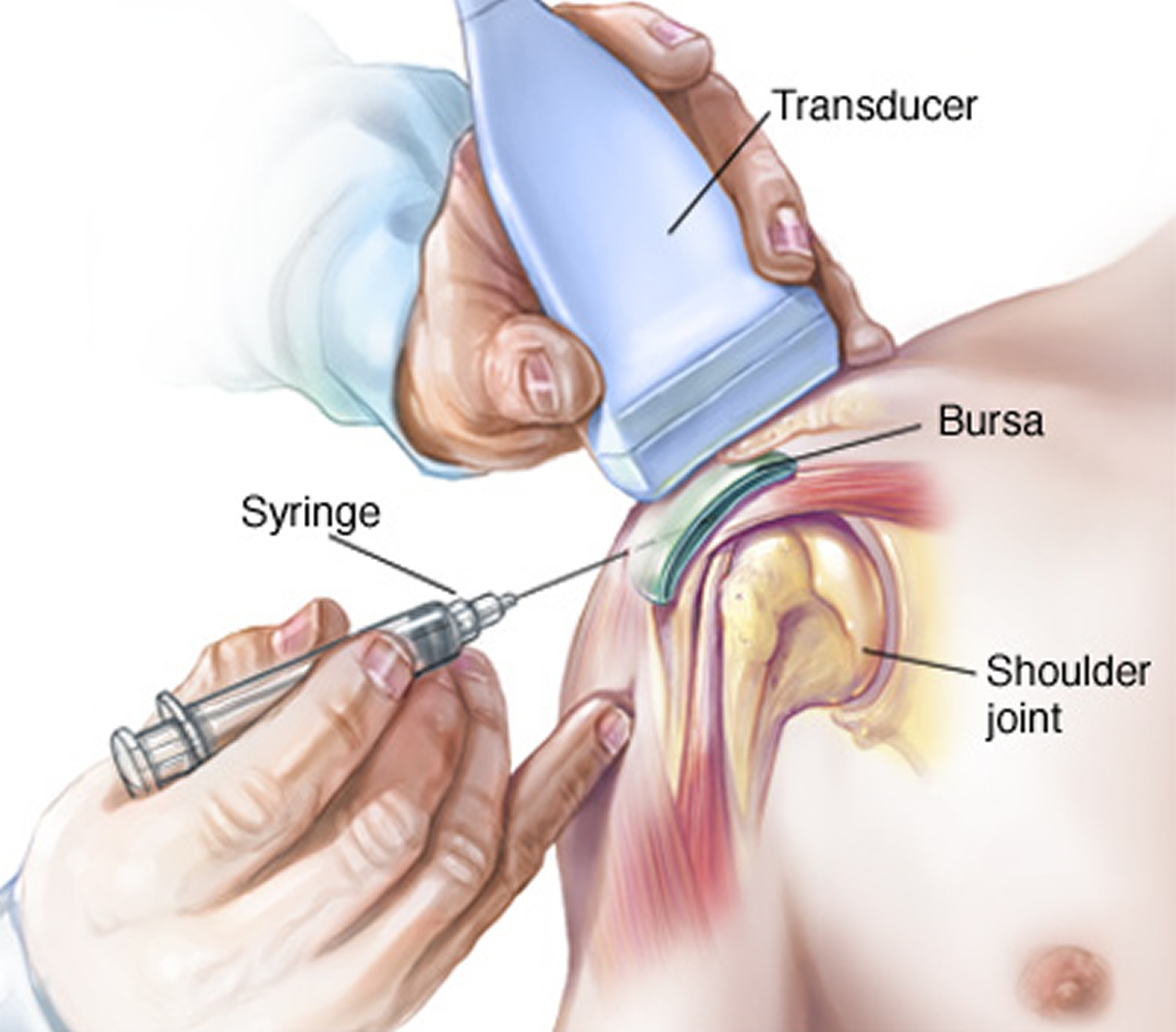 Shoulder injection