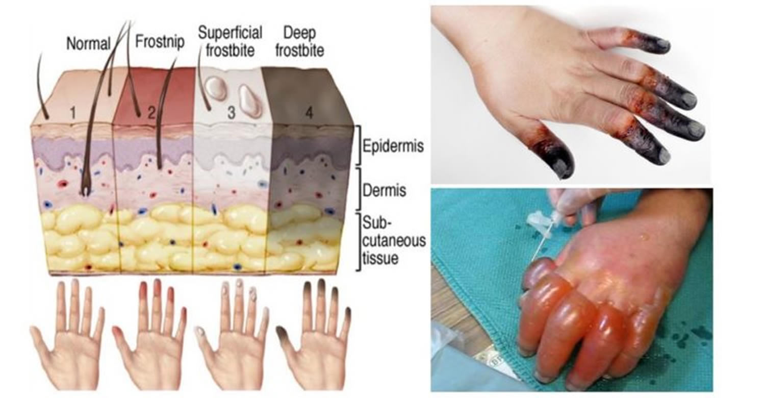 frostbite-causes-prevention-signs-symptoms-frostbite-treatment