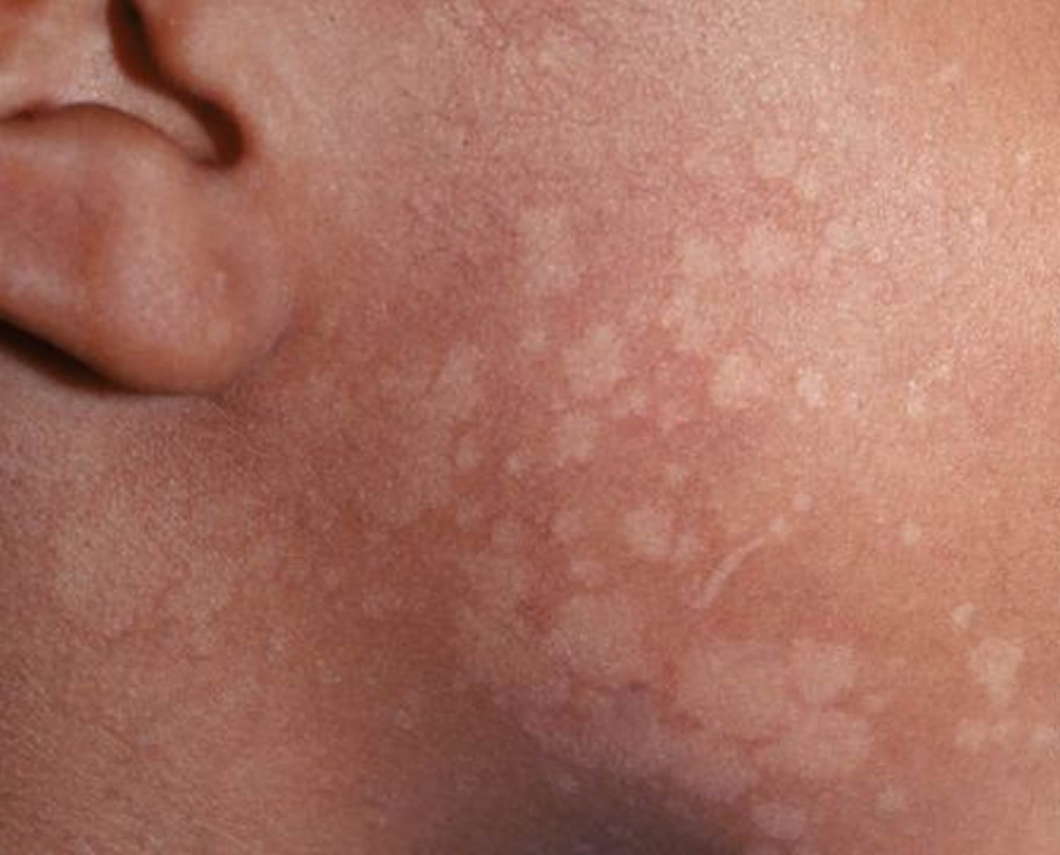 Tinea versicolor Information