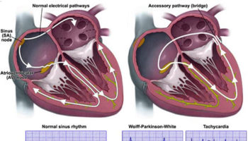 Wolff Parkinson White syndrome 1
