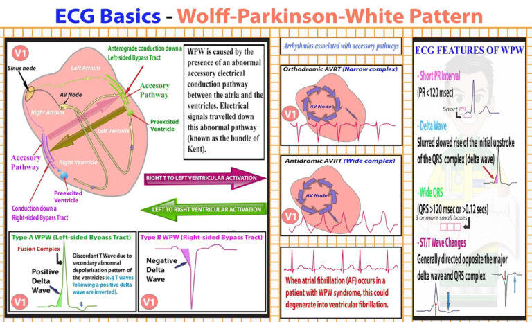 wolff-parkinson-white-syndrome-causes-symptoms-treatment