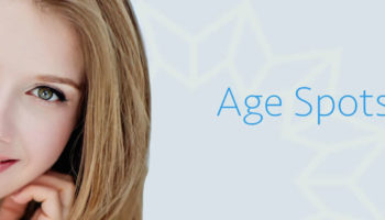 age spots