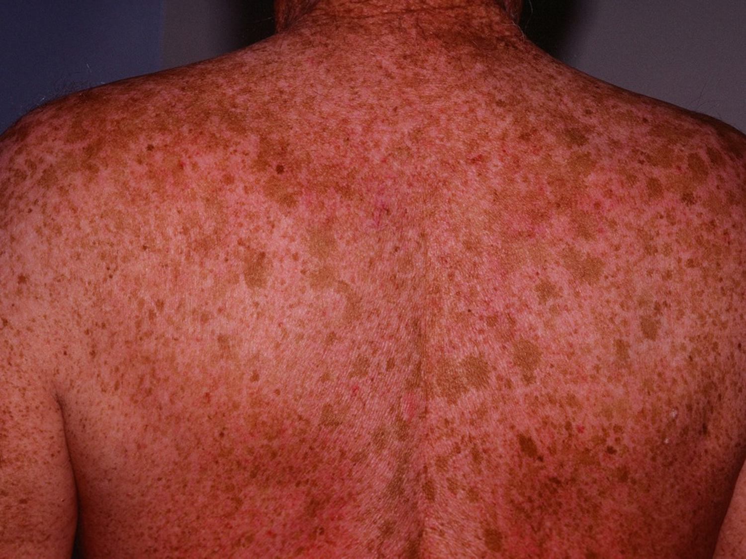 age-liver-spots-symptoms-causes-treatment-toronto-dermatology