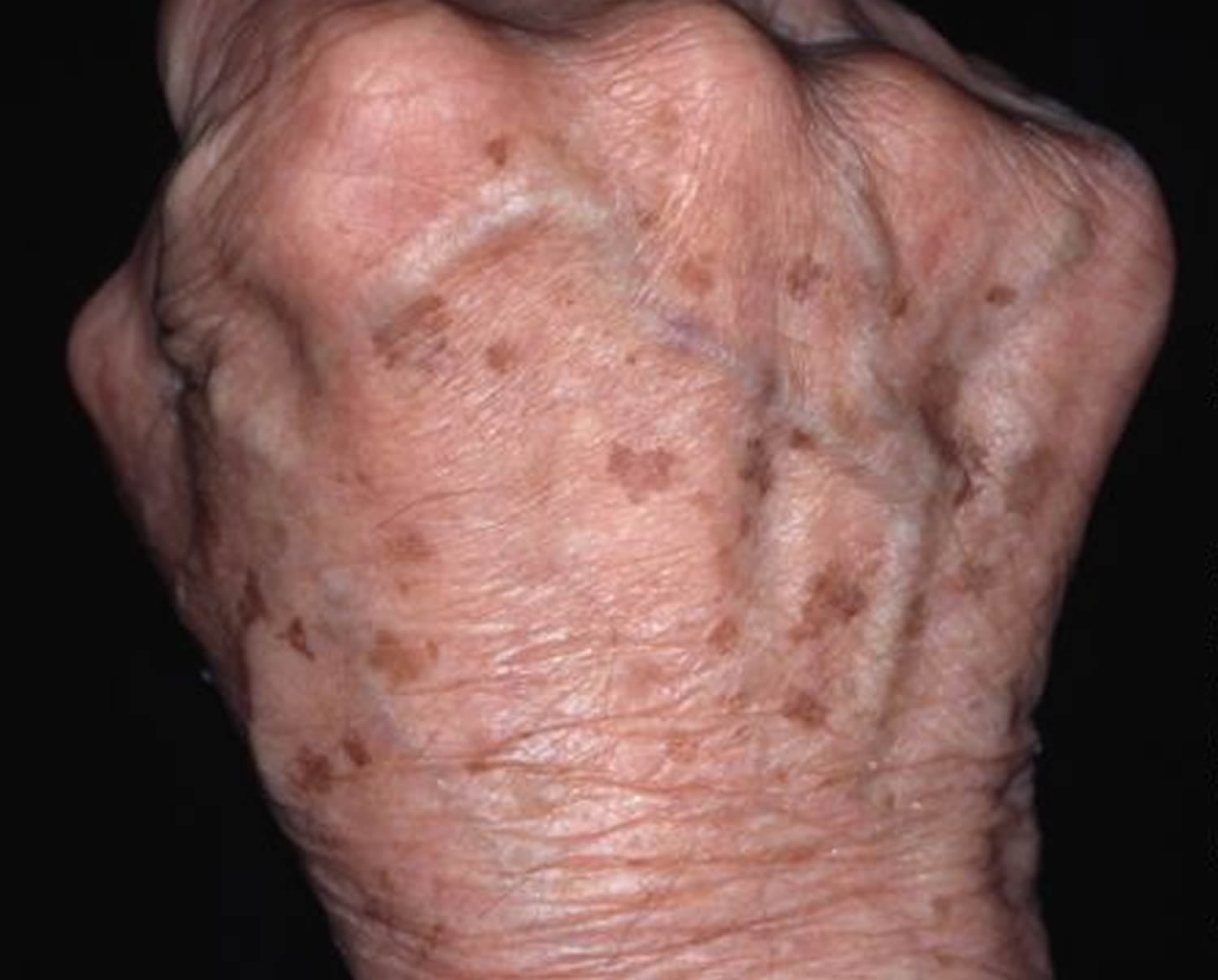 Age Spots On Hands Treatment