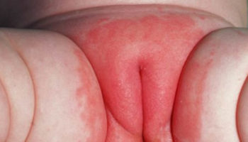 baby diaper rash