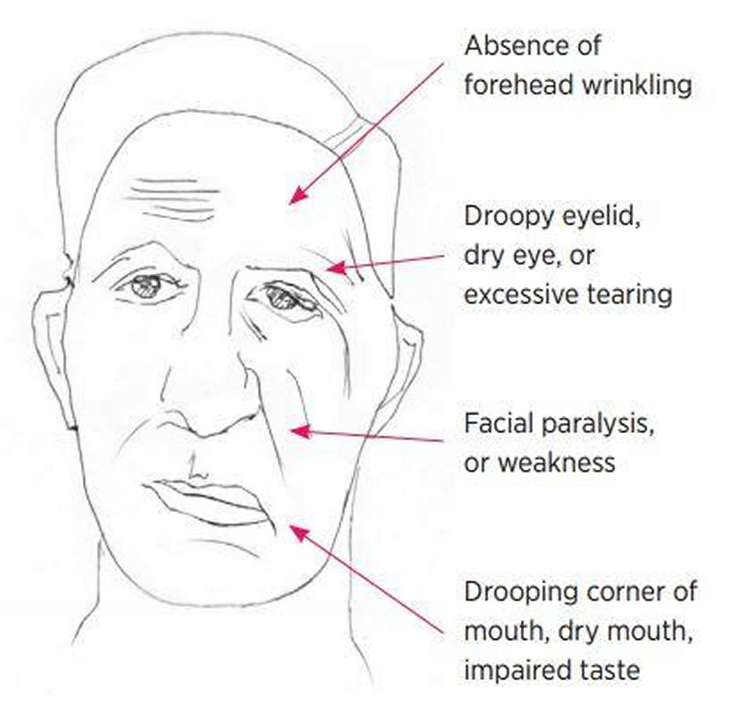 Bell's Palsy - Causes, Symptoms, Diagnosis, Recovery ...