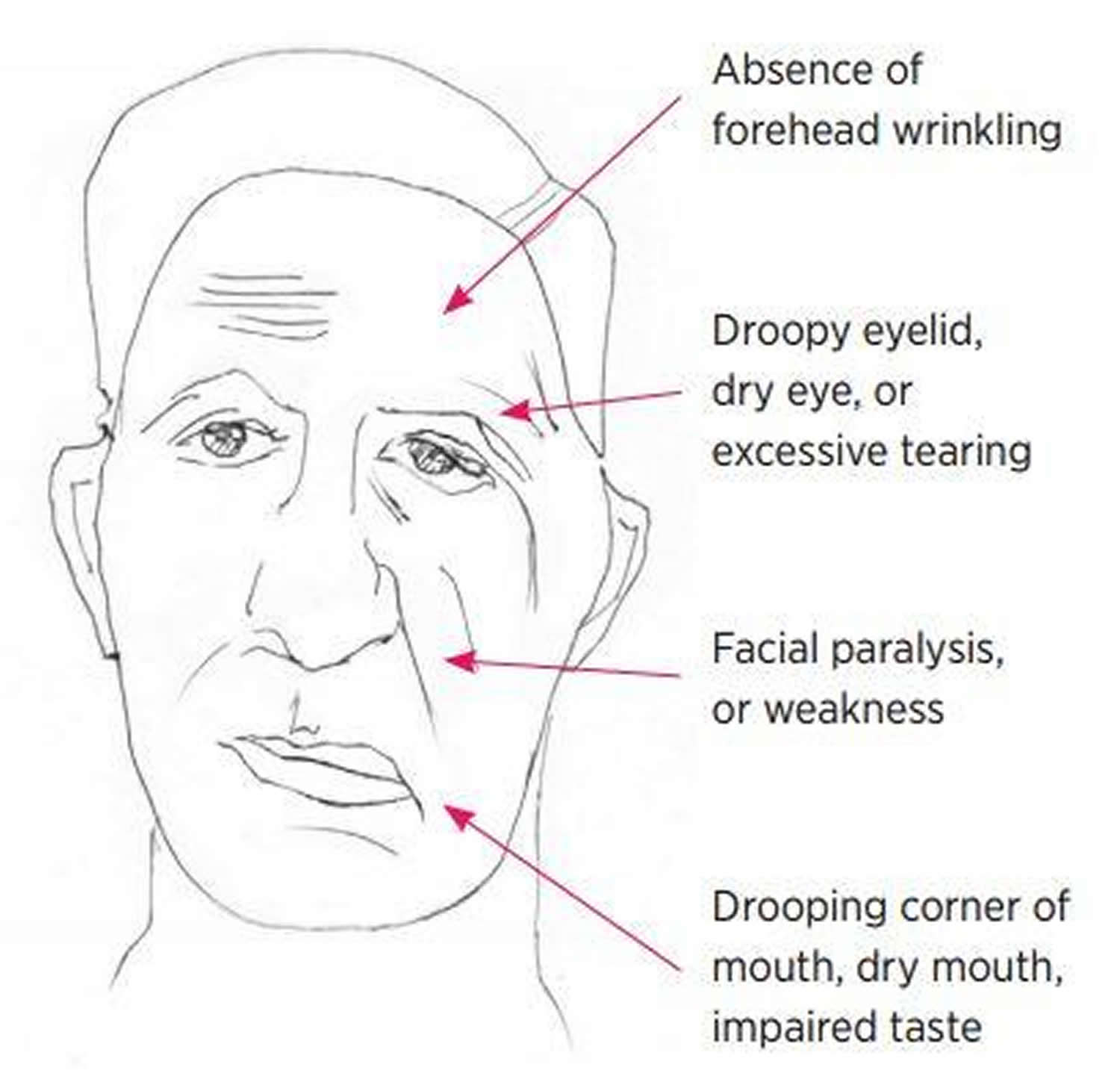 Bell's Palsy Causes, Symptoms, Diagnosis, Recovery & Treatment