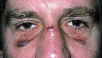broken nose