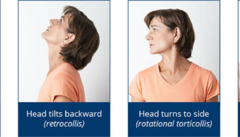 cervical dystonia