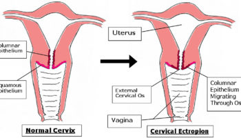 cervical ectropion